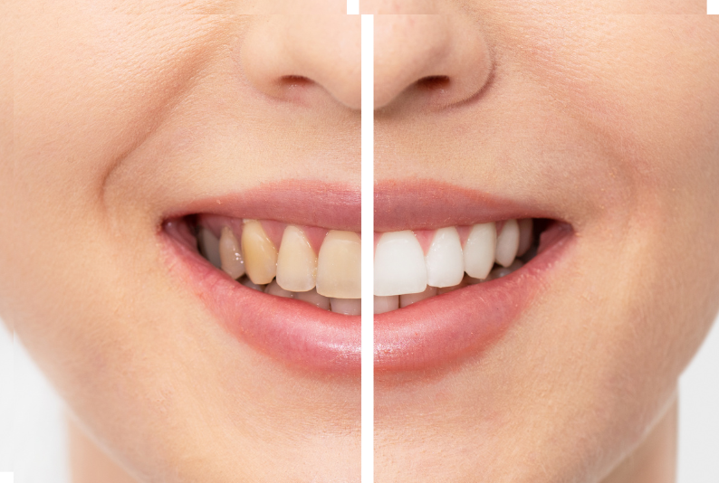 Teeth Whitening