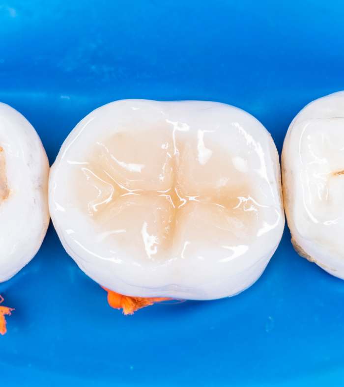 Dental Filling