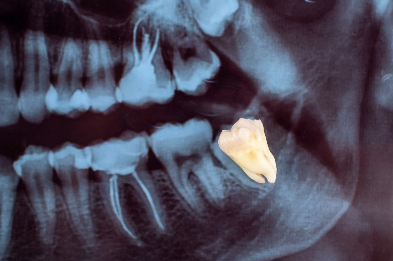 Wisdom Tooth Removal